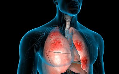 PNEUMONIA