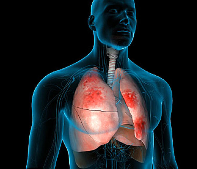 PNEUMONIA