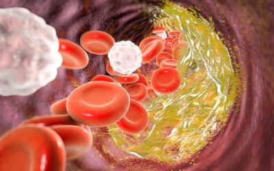 Why Heart Attacks Happen Amongst Young Adults in Nigeria