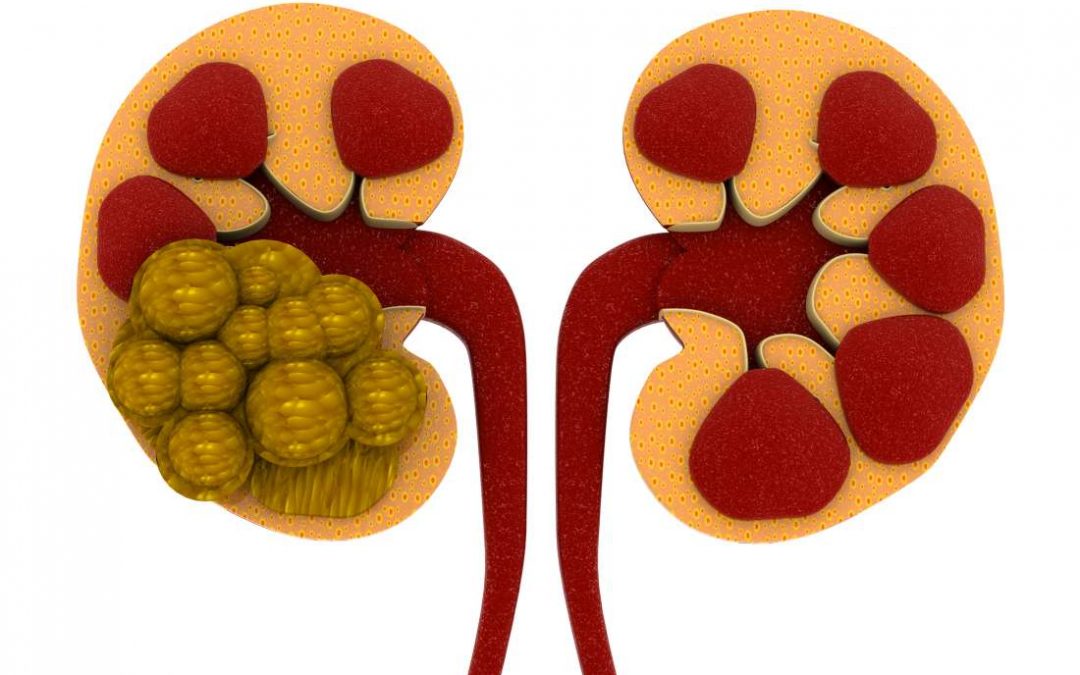 Treating and Preventing Kidney Stones with Dr. Sam, LECC Consultant Urological Surgeon
