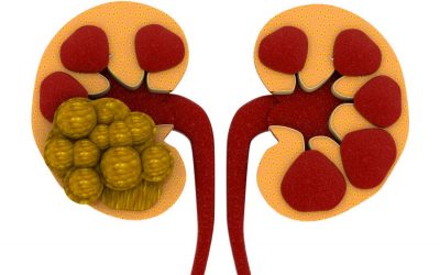 Treating and Preventing Kidney Stones with Dr. Sam, LECC Consultant Urological Surgeon