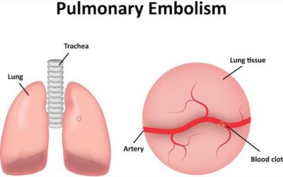 Pulmonary embolism
