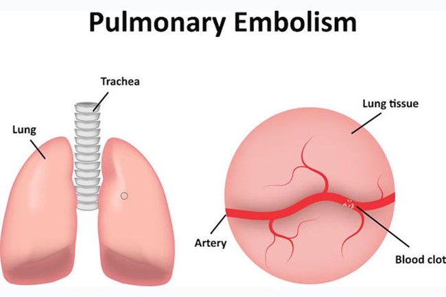 Pulmonary embolism