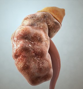 Everything You Need to Know About Kidney Failure