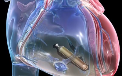 Is Your Heart a Good Candidate for a Leadless Pacemaker?
