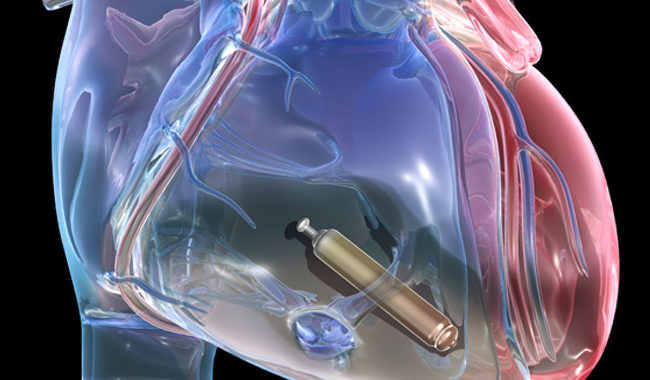 Is Your Heart a Good Candidate for a Leadless Pacemaker?