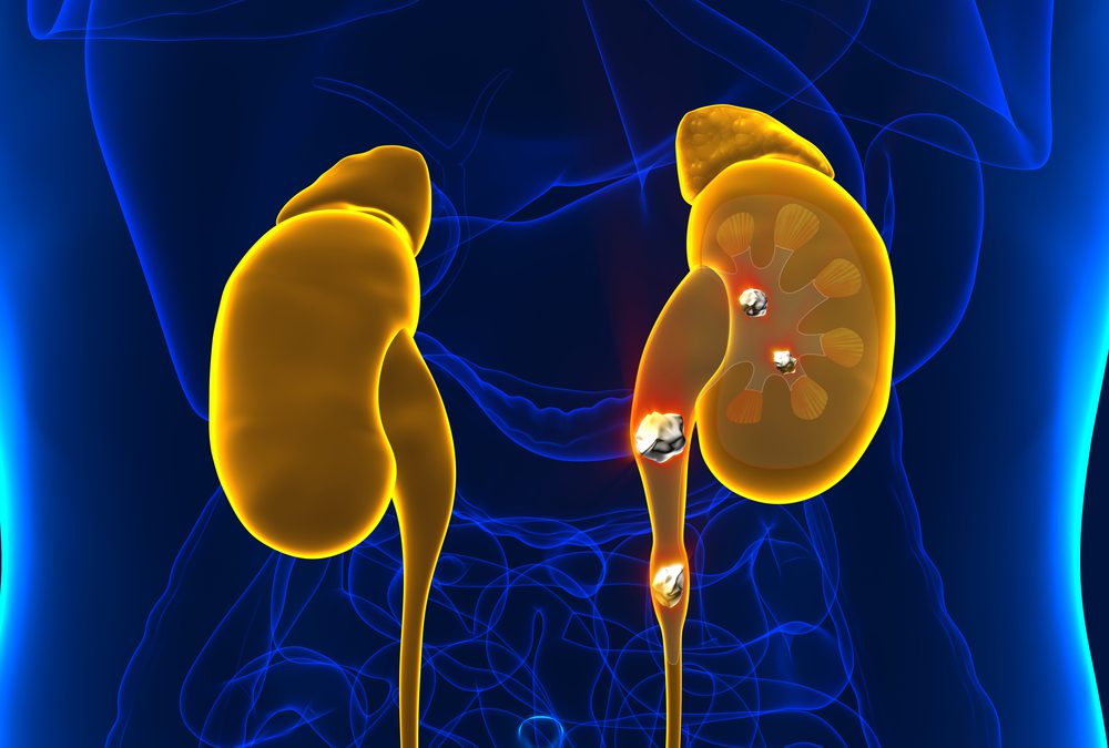 Seven Natural Ways to Prevent Kidney Stones