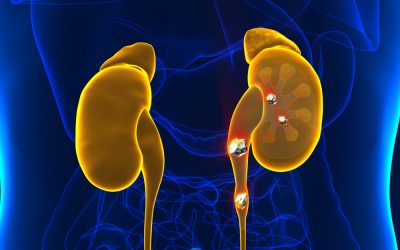 Seven Natural Ways to Prevent Kidney Stones