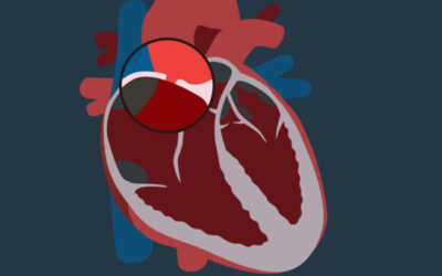 Closing the PFO Hole in Your Heart and Stroke