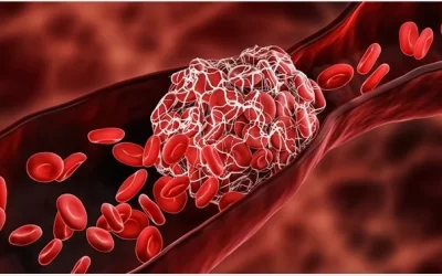 Thrombosis