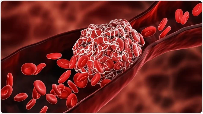 Thrombosis
